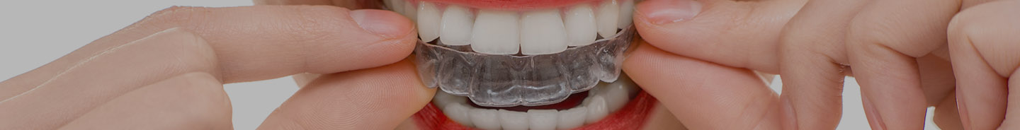 Clear Braces