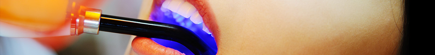 Metal Free Fillings